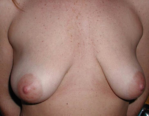 Breast Lift Before & After Image