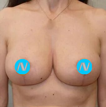 Breast Lift Before & After Image