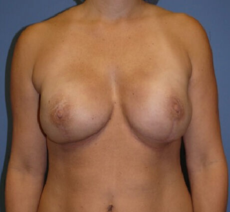 Breast Reconstruction Before & After Image