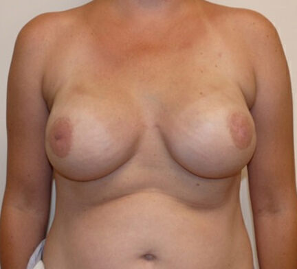 Breast Reconstruction Before & After Image