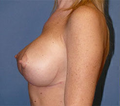 Breast Reconstruction Before & After Image