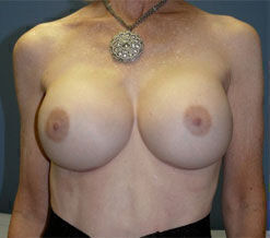 Breast Reconstruction Before & After Image