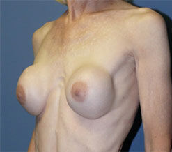 Breast Reconstruction Before & After Image