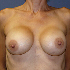 Breast Reconstruction Before & After Image