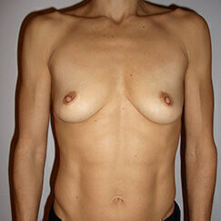 Breast Reconstruction Before & After Image