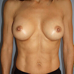 Breast Reconstruction Before & After Image