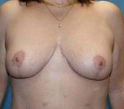 Breast Reduction Before & After Image