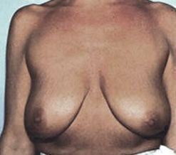 Breast Reduction Before & After Image