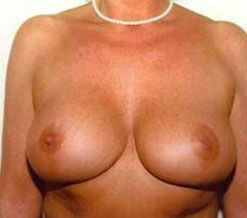 Breast Reduction Before & After Image