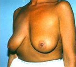 Breast Reduction Before & After Image