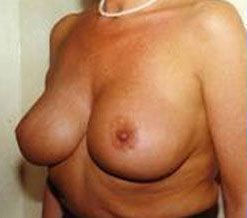 Breast Reduction Before & After Image