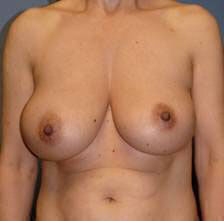 Breast Reduction Before & After Image