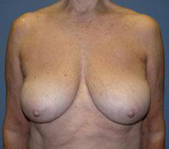 Breast Reduction Before & After Image