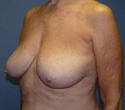 Breast Reduction Before & After Image