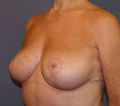 Breast Reduction Before & After Image