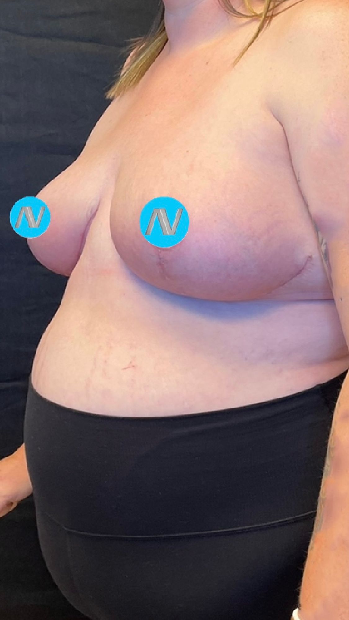 Breast Reduction Before & After Image