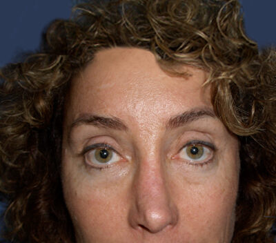 Blepharoplasty Before & After Image