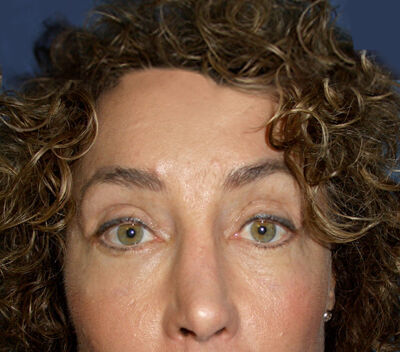 Blepharoplasty Before & After Image