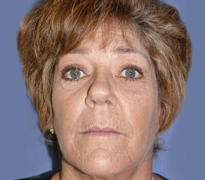 Blepharoplasty Before & After Image