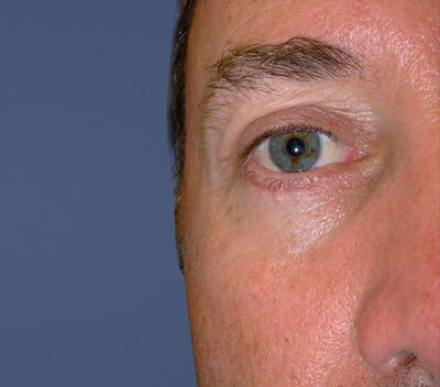 Blepharoplasty Before & After Image