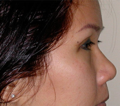 Blepharoplasty Before & After Image