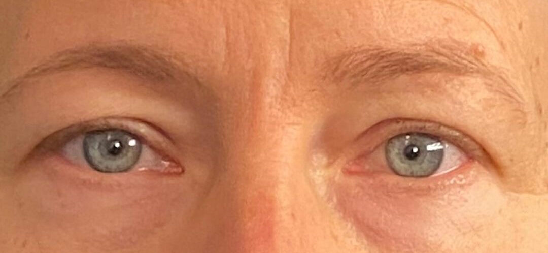 Blepharoplasty Before & After Image