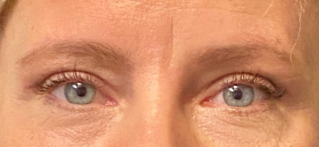 Blepharoplasty Before & After Image