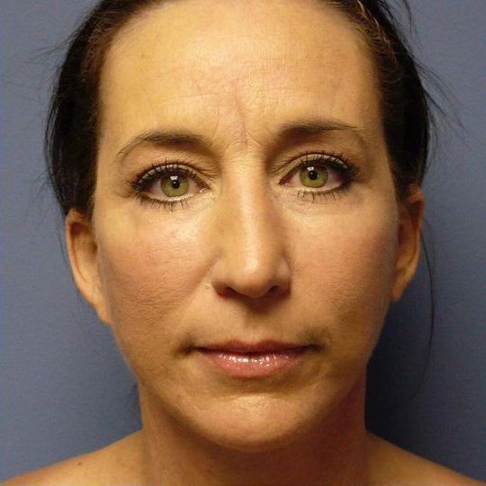 Blepharoplasty Before & After Image