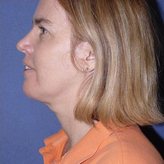 Chin Augmentation Before & After Image