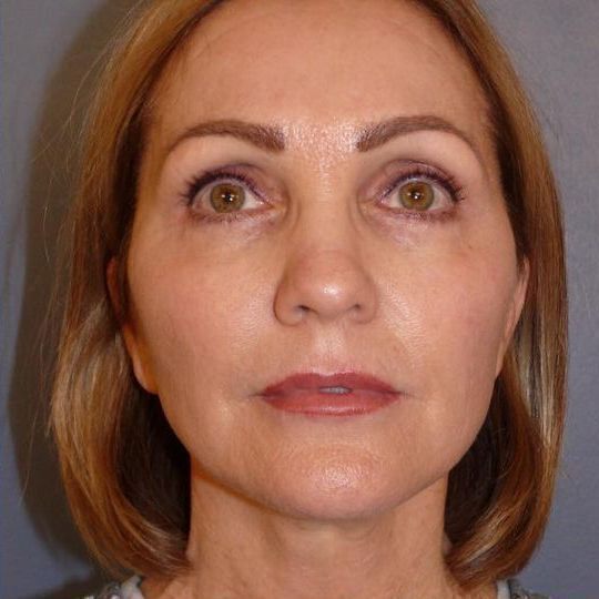 Deep Plane Facelift Before & After Image