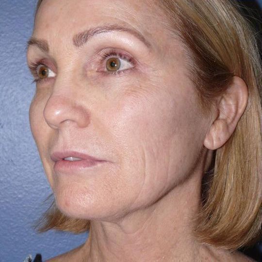 Deep Plane Facelift Before & After Image