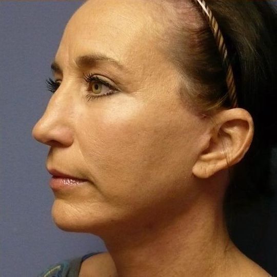 Deep Plane Facelift Before & After Image