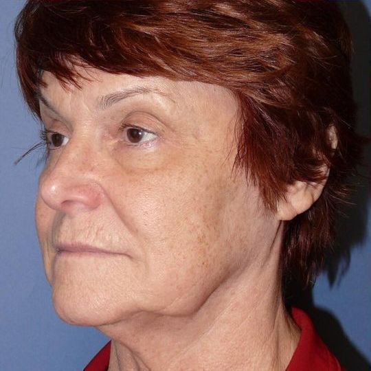 Deep Plane Facelift Before & After Image