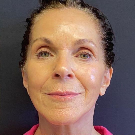 Deep Plane Facelift Before & After Image