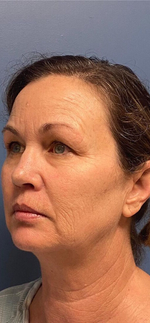 Deep Plane Facelift Before & After Image