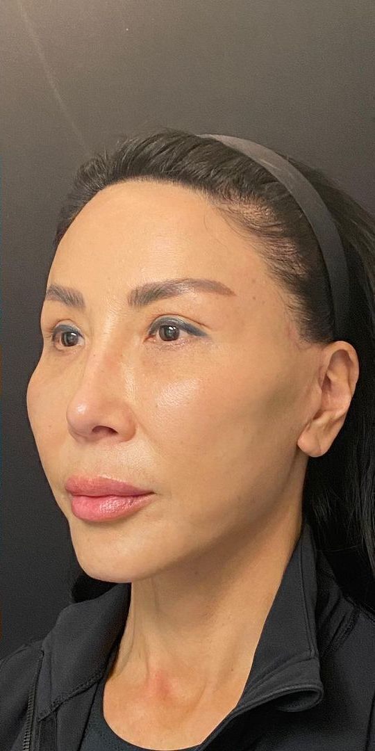 Deep Plane Facelift Before & After Image