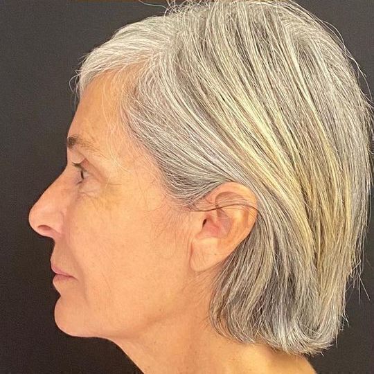 Deep Plane Facelift Before & After Image