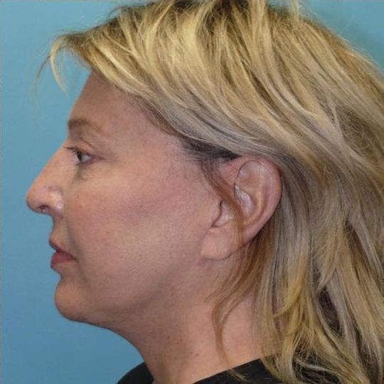 Deep Plane Facelift Before & After Image