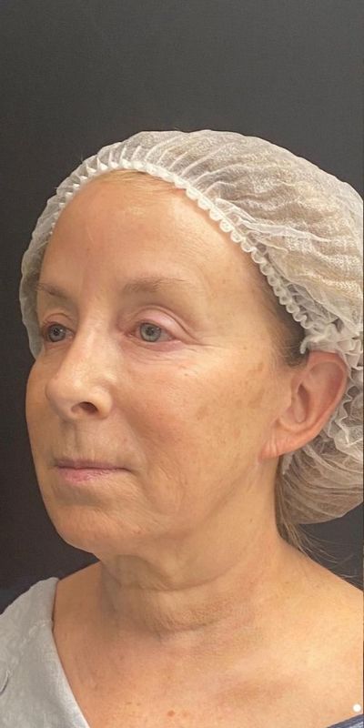 Deep Plane Facelift Before & After Image