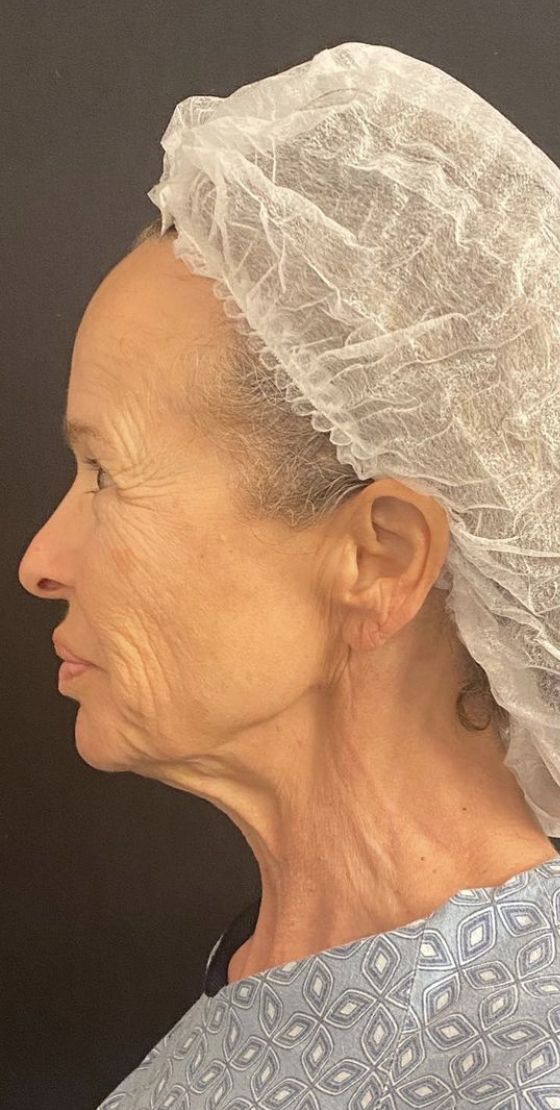 Deep Plane Facelift Before & After Image