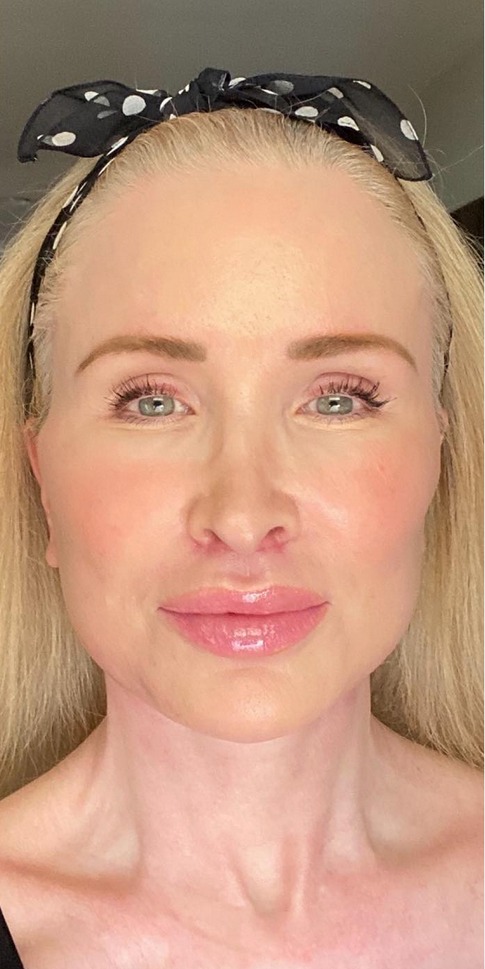 Deep Plane Facelift Before & After Image