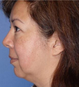 Deep Plane Facelift Before & After Image