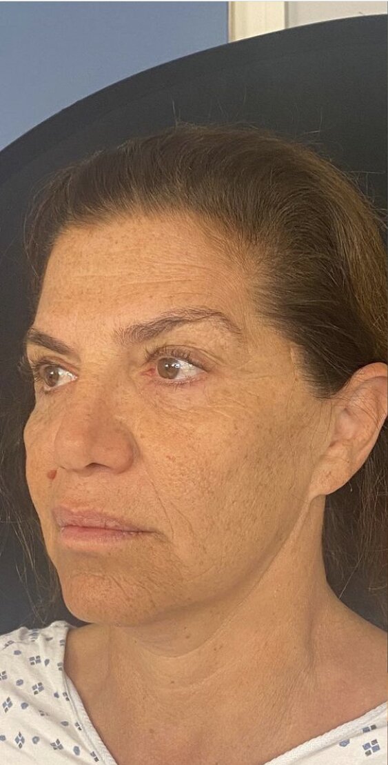 Deep Plane Facelift Before & After Image