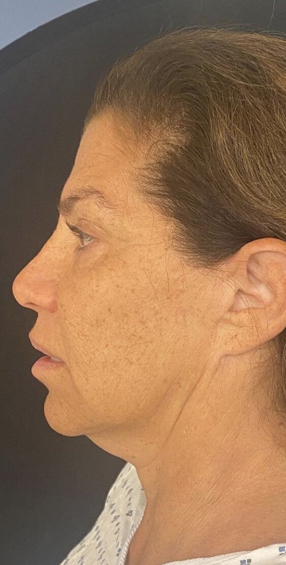 Deep Plane Facelift Before & After Image