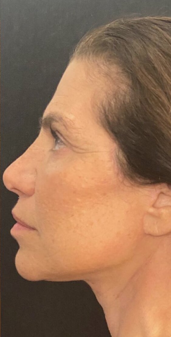 Deep Plane Facelift Before & After Image