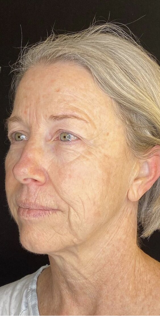 Deep Plane Facelift Before & After Image