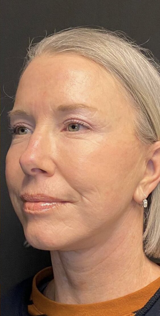 Deep Plane Facelift Before & After Image