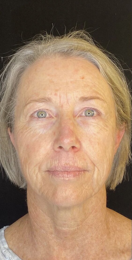 Deep Plane Facelift Before & After Image