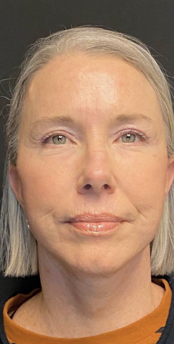 Deep Plane Facelift Before & After Image