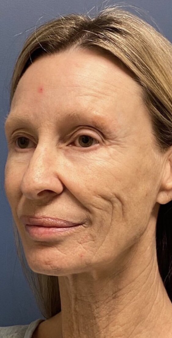 Deep Plane Facelift Before & After Image